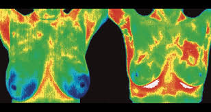 The Benefits of Breast Cancer Screening with Thermography