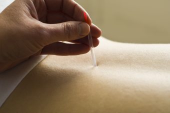 Benefits of Acupuncture for the body 
